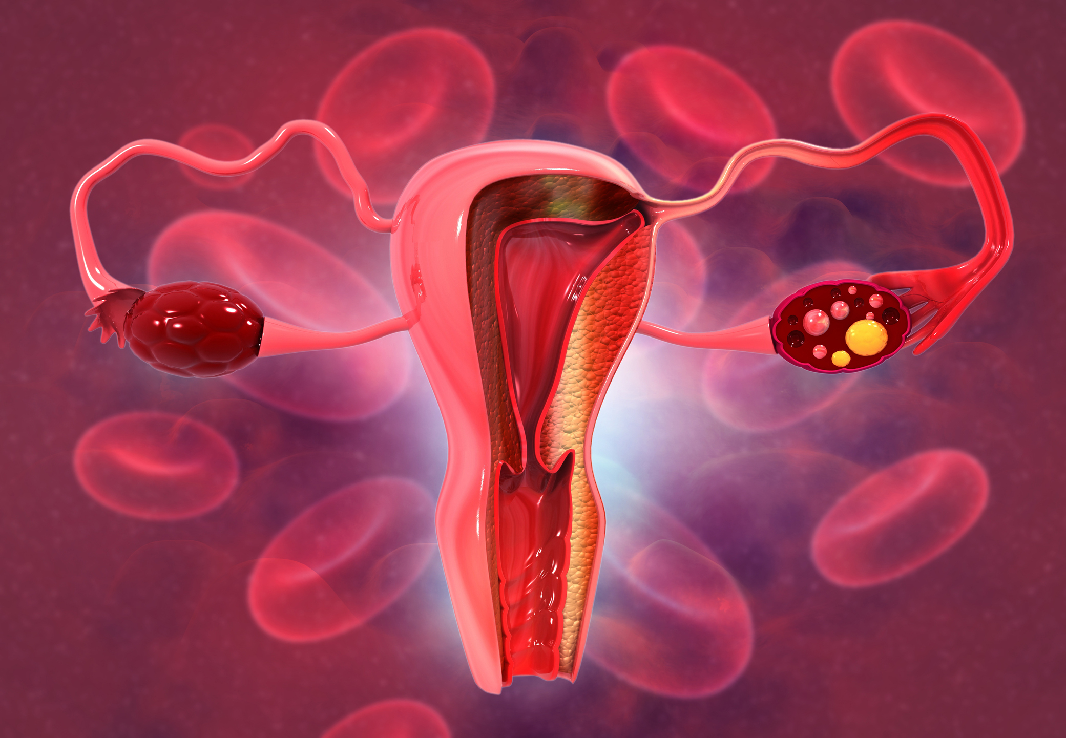 Síndrome de Ovario Poliquístico (SOP): Un enfoque basado en la investigación